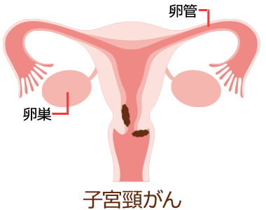 子宮がん | 婦人科の相談