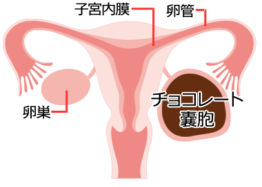 子宮内膜症 | 婦人科の相談