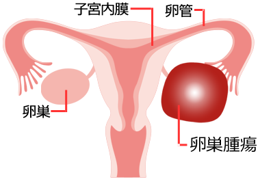 卵巣腫瘍 | 婦人科の相談